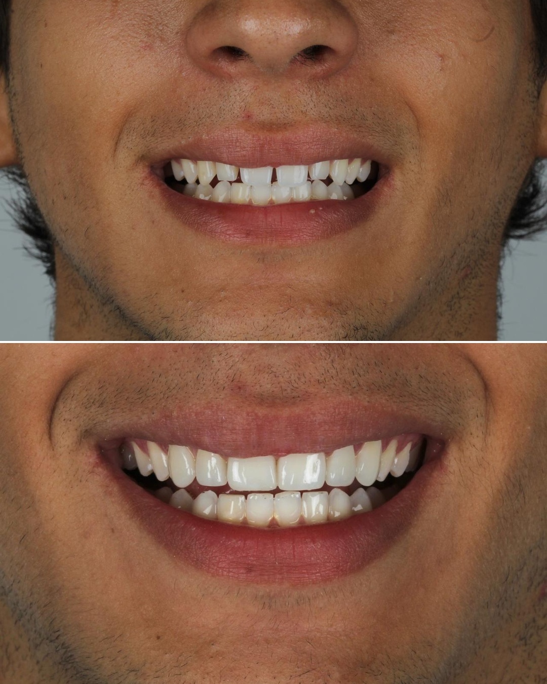 Resultado real de paciente, antes e depois, GS Odontologia